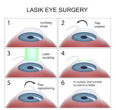 Lasik Eye Surgery Mumbai Is A Professional Website Http Lasikeyesurgerymumbai In Which Provides You With Informati Lasik Eye Surgery Lasik Surgery Lasik