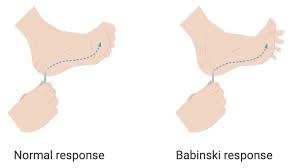 Image result for Babinski Reflex