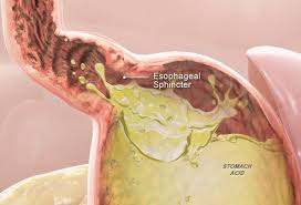 When you talk to your doctor about heartburn, the doctor will first ask. Visual Guide To Understanding Heartburn And Gerd