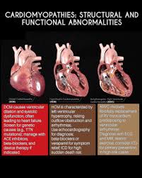 Image result for Cardiomyopathy
