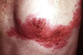 Image result for shingles