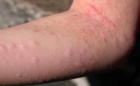 17 Causes And Symptoms Of Hives Skin Allergies Natural Cure For Allergies Cure For Allergies