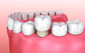 In fact, 36 percent of americans have no dental insurance. Types Of Dental Crowns And Cost A Complete Guide 2021