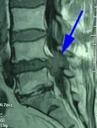 Sagittal mri of a patient with cauda equina syndrome secondary to a large lumbar disk herniation. Cauda Equina Syndrome Manchester Chiropractic Amp Sports Injuries