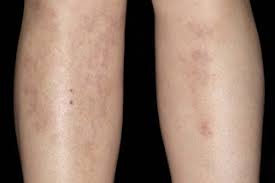 Image result for erythema nodosum