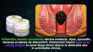 Medicamentul este absorbit de țesutul rectal și poate ajuta la tot disconfortul și durerea supozitoarele sunt o opțiune de tratament pentru hemoroizi. Hemoroizi Interni Gradul I Ii Iii Iv Afla Cand Trebuie Sa Mergi La Medic Pentru Tratament Youtube
