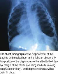 Normally, the outer surface of the lung sits next to the inner surface of . Cfcdn Aerzteblatt De Bilder 118467 800 0