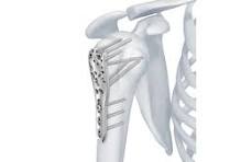 3.5 mm LCP™ Proximal Humerus Plates | Products | DePuy Synthes