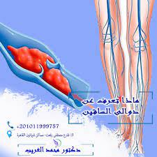 دوالى الساقين