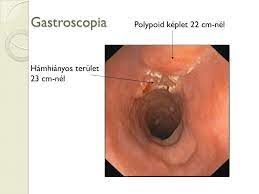 Nyelocso Leiomyoma Es Laphamcarcinoma Uj Kapcsolat Ppt Letolteni