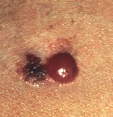 We may earn commission from links on this page, but we only r. Amelanotic Melanoma Pictures Symptoms And Prognosis