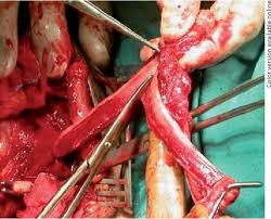 Maybe you would like to learn more about one of these? Male To Female Transsexualism Technique Results And 3 Year Follow Up In 50 Patients Semantic Scholar