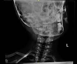 C1 C2 Subluxation After Mild Cervical Spine Trauma In A Child Surgical Case Reports Science Repository Open Access