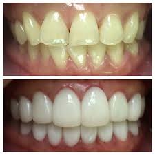Mulpix Before And After Of A 25yr Old Female Flight Attendant Patient With Yellowish Crooked Teeth Treated With Dental Veneers Veneers Teeth Porcelain Veneers