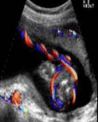 Nuchal Cord Wikipedia