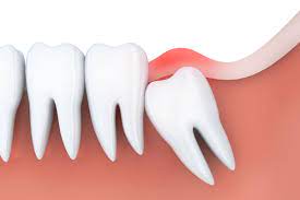 Dec 03, 2016 · crowd nearby teeth. The Wisdom Tooth Removal Process In 2018 From 123dentist
