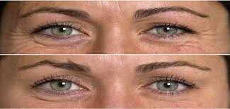 Chez l'homme, leur ingestion est responsable du botulisme, mais des cas secondaires à une infection digestive ou cutanée par clostridium botulinum peuvent survenir comme pour le tétanos. Les Injections De Botox Ou Toxine Botulique En Esthetique Avis Afme Afme