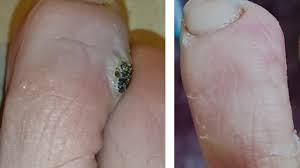 Repeat for several nights until it's gone. Verruca Wart Best Way To Get Rid Of Viral Verruca Wart Youtube