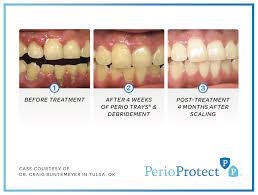 56082 Dentist | Valley View Dental | Gum Disease Treatment