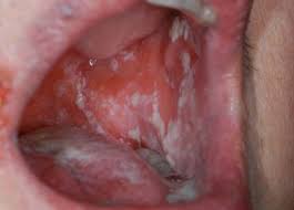 Most likely you do have one. Oral Yeast Infections
