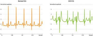 Automated Detection Of Coronary Artery Disease Using Different Durations Of Ecg Segments With Convolutional Neural Network Sciencedirect
