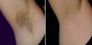 Laser underarm hair removal machines work by sending wavelengths of light to the hair root or follicles. Good Under Arm Laser Hair Removal Before And After Laser Hair Removal Laser Hair Best Laser Hair Removal