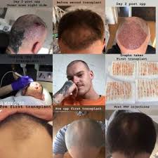Did steve carell get a hair transplant. Hair Loss Is Toss Sharing A Journey Through The Not So Wonderful World Of Male Pattern Baldness Hairlossistoss