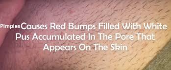 There are certain risk factors that make a woman more prone to ingrown hairs, pai says. Difference Between Herpes Std Vs Genital Grains Vs Pimples Or Ingrown Hair Cyst Std Testing Near Me