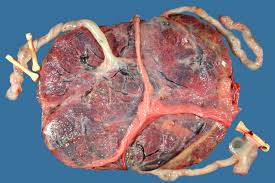 Pourquoi prescrire un dosage du fer ? Placenta Neufmois Fr