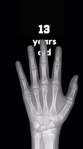 Image result for Hand Growth Plates