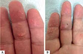 Tophi are chunks of uric acid (monosodium urate) crystals that accumulate in and around joints and other parts of the body as the result of advanced. Scielo Brasil Finger Pad Tophi In Gout A Rare Presentation Finger Pad Tophi In Gout A Rare Presentation
