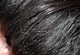Image result for pubic lice symptoms