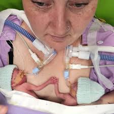 Kaydee was just over 23 weeks pregnant when she felt tightening, but  thought it was Braxton Hicks contractions. Braxton Hicks contractions are  the body's way of preparing for labour. It's a tightening