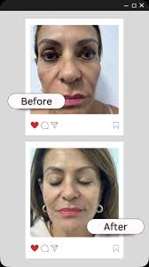 Say goodbye to dark spots and hello to radiant skin! , ✨ IPL laser  treatment targets pigmentation, giving you a clearer, more even complexion.  , Book your session today! , #IPLLaser #FlawlessSkin ...