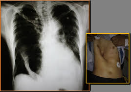 Severe cases of pectus excavatum can eventually interfere with the function of the heart and lungs. Marfan Syndrome With Aortic Dissection And Background Severe Pectus Excavatum Radiology Case Radiopaedia Org