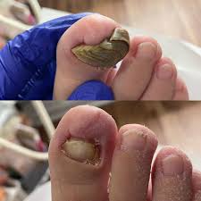 Image result for Onychogryphosis feet