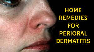 3 the de la cruz treatment is my favorite; Home Remedies To Get Rid Of Perioral Dermatitis Overnight Remedies For Perioral Dermatitis Youtube