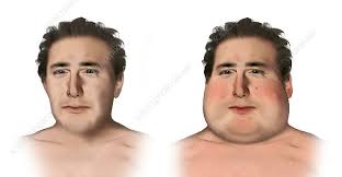 Cushing S Syndrome Illustration Stock Image C024 0615 Science Photo Library