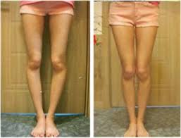 Pretty Legs Care Leg Correction Care Bowed Legs Legs Straightening Bow Legs Bow Legged Correction Bow Legged Leg Transformation