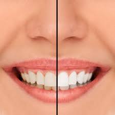 Coffee teeth stains tend to either be an overall darkness on your teeth or isolated specks of black or brown stain. Can Porcelain Veneers Be Whitened Dr Raminder Singh General Dentistry