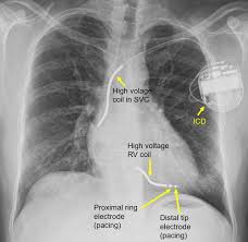 Pertinent factors relating to each manufacturer's devices are referenced according to: Cardiac Implantable Electronic Devices Cied On Cxr