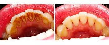 Maybe you would like to learn more about one of these? How To Remove Coffee Stains From Teeth At Home Teethwalls
