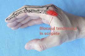 Utset explica ca degetele se pot dezumfla daca persoana respectiva isi foloseste mainile si continua activitatile pe care le face de obicei, dar avertizeaza ca sanguine la nivelul degetelor de la picioare si maini si poate fi cauzat de vremea rece sau stres. Deget Umflat Si Vanat La Mana Despre ViaÈ›a Din Romania