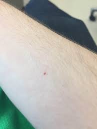 An angioma is a cluster of blood vessels at the surface of the skin and removal is super easy and can be done at home. Cherry Angioma Or Petechia Skincareaddiction