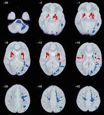Aspergers has not yet been identified in the brain. White Matter Brain Structure In Asperger S Syndrome Springerlink