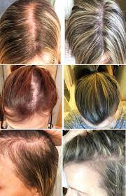 It can make you lose hair suddenly and seemingly out of the blue, according to nyu langone health. Pin On Bloggy Moms