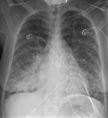 Image result for Transfusion Associated Circulatory Overload