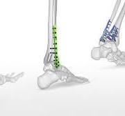 Foot & Ankle | Acumed