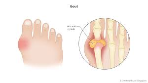 Image result for gout symptoms toe