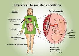 Cureus A Comprehensive Review Of The Manifestations And Pathogenesis Of Zika Virus In Neonates And Adults